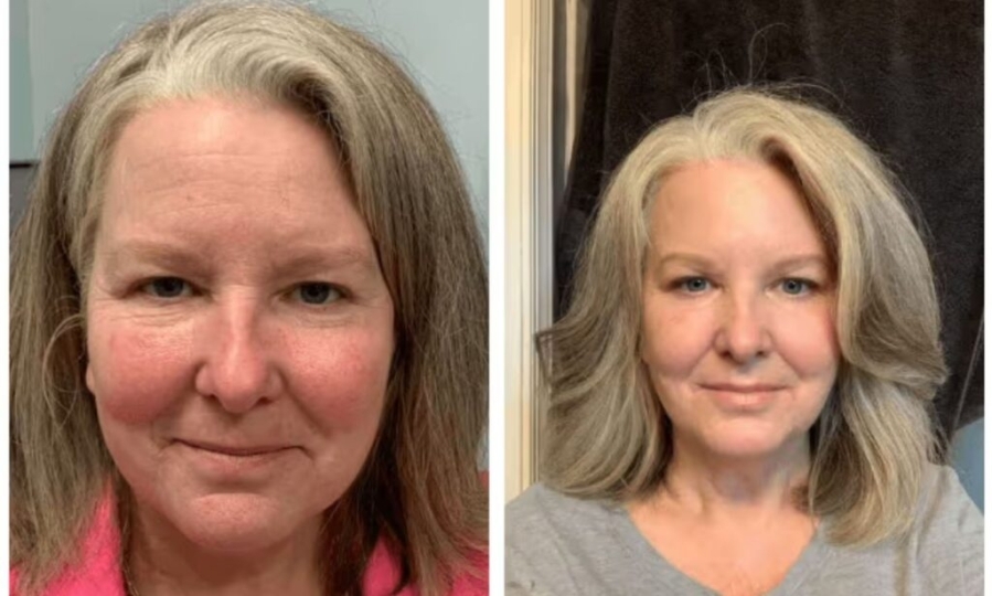 TCA Peel for radiant skin
My Journey with the TCA Peel: How I Reversed Sun Damage and Achieved Radiant Skin