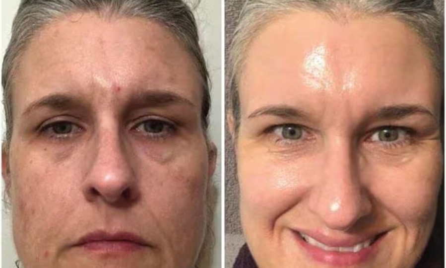 TCA Peel for radiant skin
My Journey with the TCA Peel: How I Reversed Sun Damage and Achieved Radiant Skin