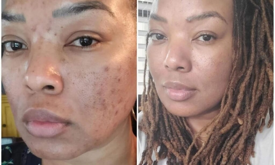 TCA Peel for radiant skin
My Journey with the TCA Peel: How I Reversed Sun Damage and Achieved Radiant Skin