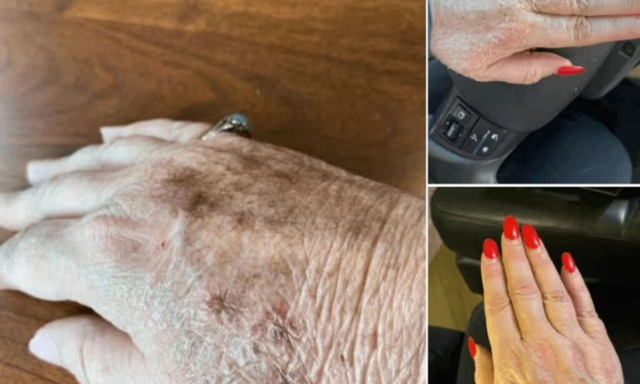 TCA Peel for radiant skin
My Journey with the TCA Peel: How I Reversed Sun Damage and Achieved Radiant Skin