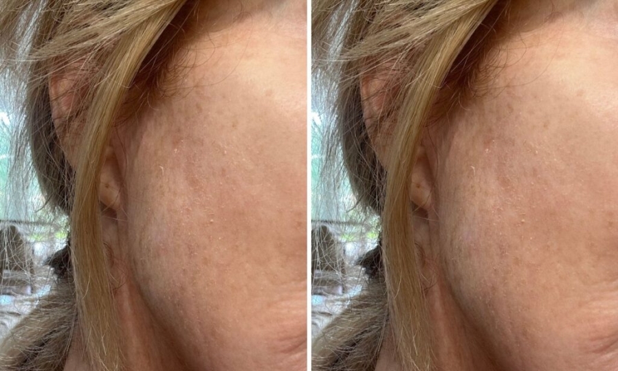 TCA Peel for radiant skin
My Journey with the TCA Peel: How I Reversed Sun Damage and Achieved Radiant Skin